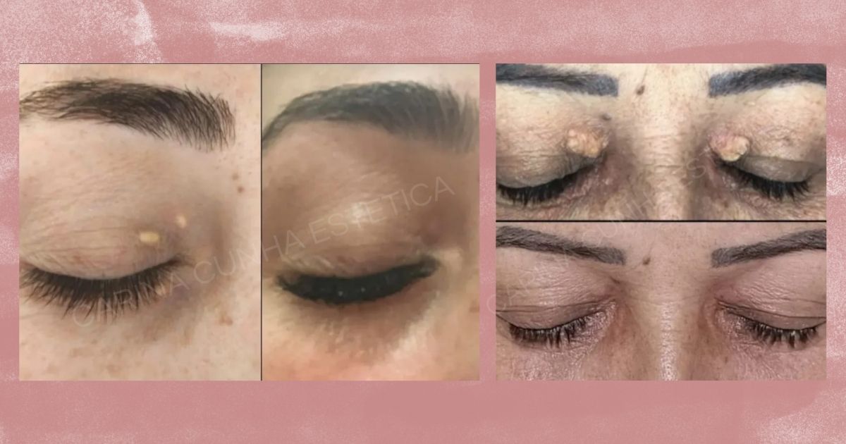 Antes e Depois de Remoção de Sinais