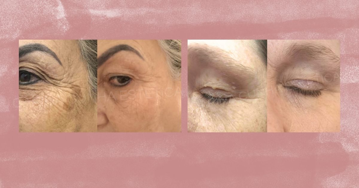 Antes e Depois de Retração de Milium