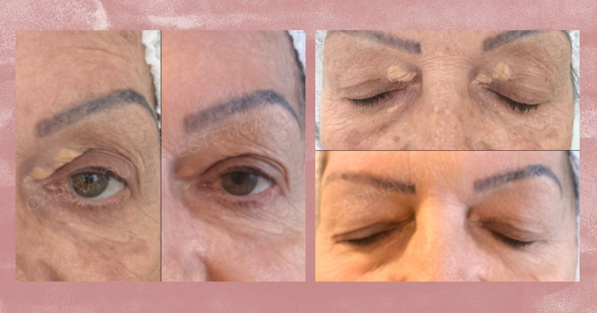 Antes e Depois de Tratamento de Xantelasma